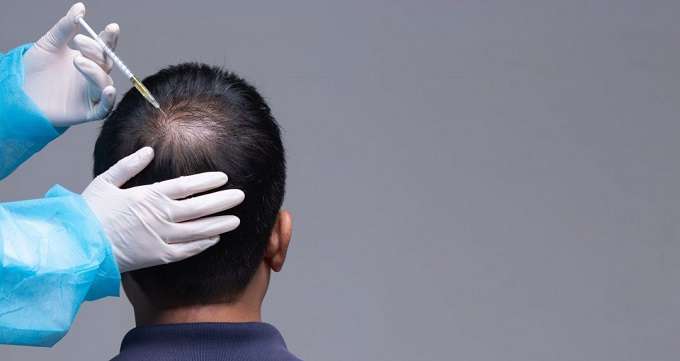 ریزش مو در مردان : درمان و راه حل ها