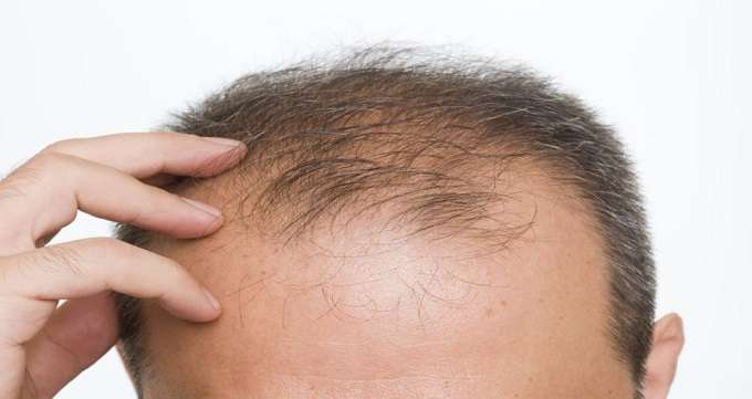 درمان ریزش مو : فیناسترید