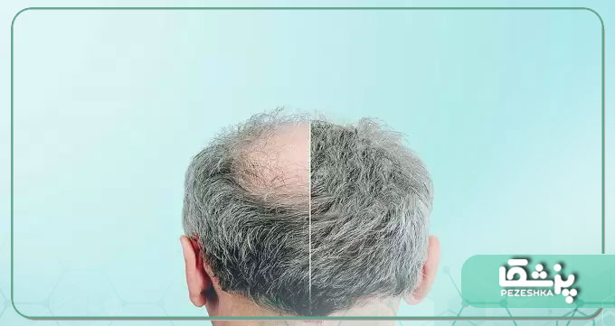 کاشت مو در افراد سالمند