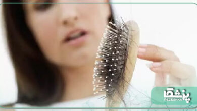 درمان ریزش موی مردان