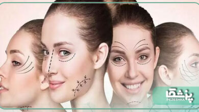 مزایا و معایب لیفت صورت با نخ