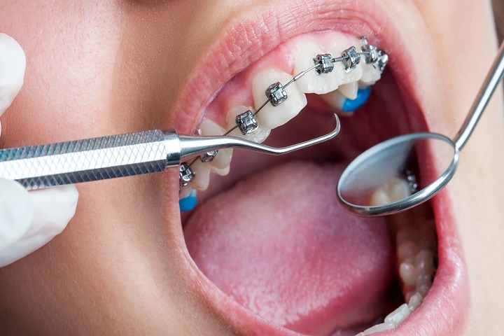 آیا خطر پوسیدگی دندان با ارتودنسی افزایش می یابد؟