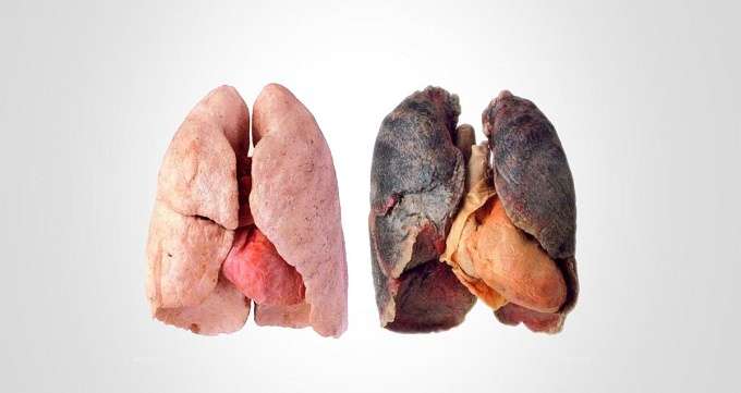 بیماری های ریوی از طریق استعمال دخانیات