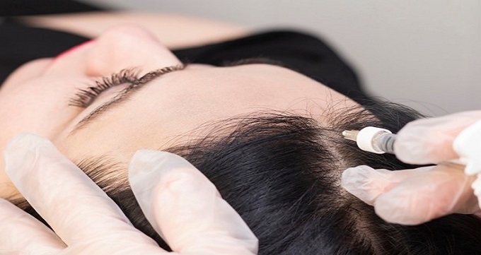 روش کاشت مو به وسیله سلول‌های بنیادی چیست