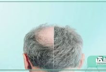 روش کاشت مو به وسیله سلول‌های بنیادی چگونه است؟