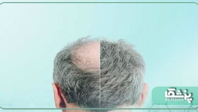 روش کاشت مو به وسیله سلول‌های بنیادی چگونه است؟