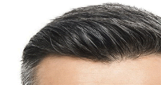سن مناسب برای جراحی کاشت موی سر