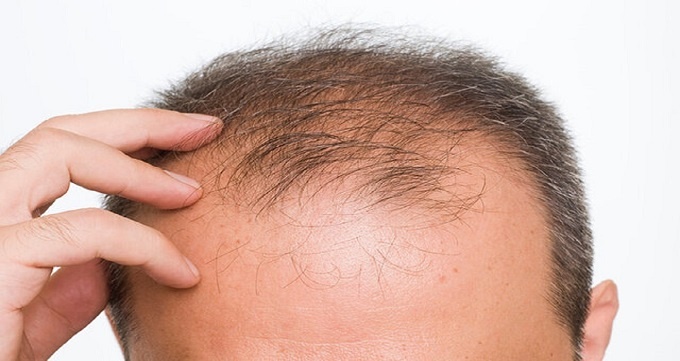 هزينه درمان ريزش مو در تبريز چه مقدار مي باشد؟
