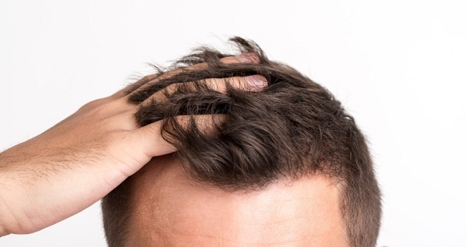 چه روش هایی برای درمان ریزش مو وجود دارد ؟
