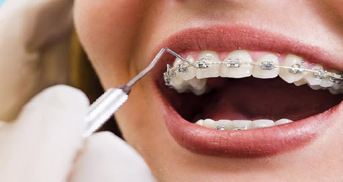 ارتودنسی چگونه به درمان فاصله بین دندان ها کمک می کند ؟