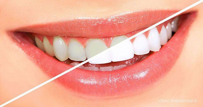 انواع روش های زیبایی و ترمیمی دندان به چه صورت است ؟