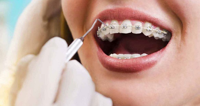چگونه می توان برای زيبايی دندان ها از كامپوزيت كمك گرفت؟