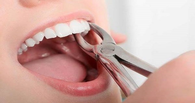 دندان عقل را باید به چه صورت جراحی کرد ؟