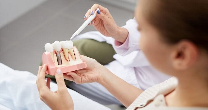  ایمپلنت دندان چیست؟