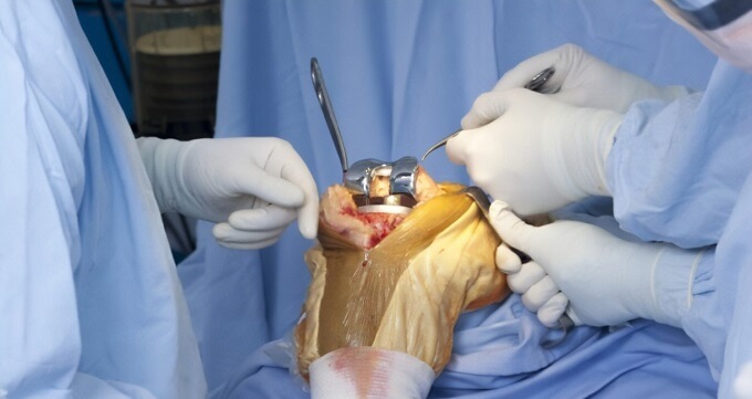 عمل جراحی زانو چیست؟