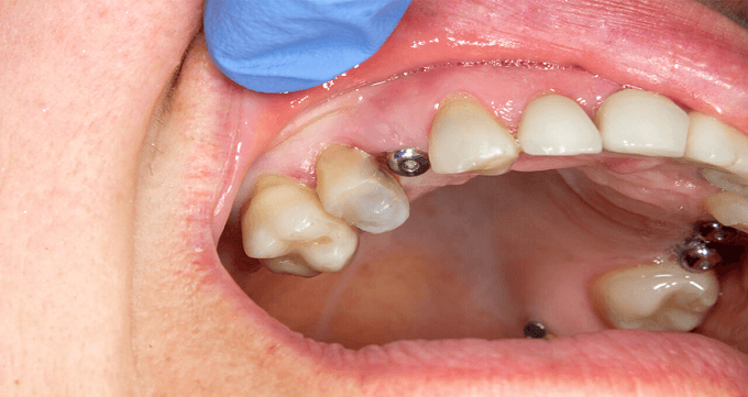 ایمپلنت دندان چه مزایایی دارد؟