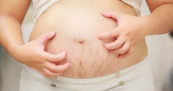 درمان ترک پوست بارداری 