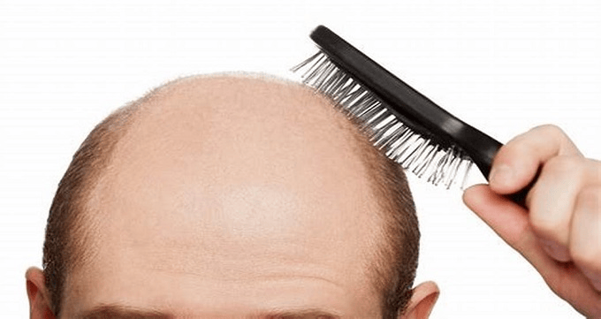 کاشت مو چیست؟