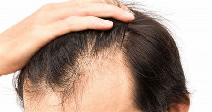 کاشت مو چه عوارض جانبی به همراه خواهد داشت؟