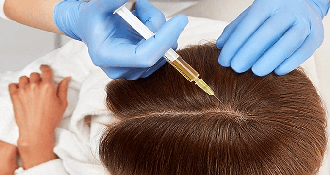 مزوتراپی مو چه عوارض جانبی به همراه خواهد داشت؟