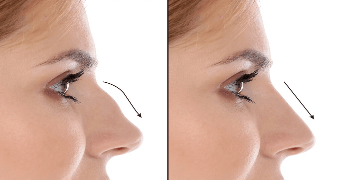 نکات مراقبتی قبل از جراحی بینی