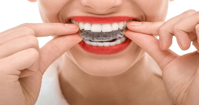 انواع مختلف ارتودنسی دندان