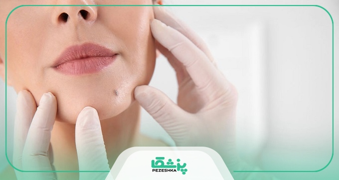نکات مراقبتی پس از برداشتن خال