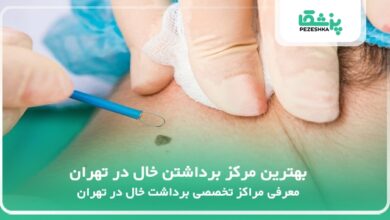 بهترین مرکز برداشتن خال در تهران