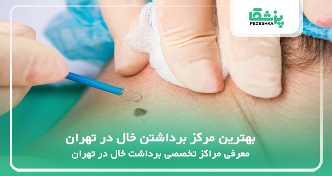 بهترین مرکز برداشتن خال در تهران
