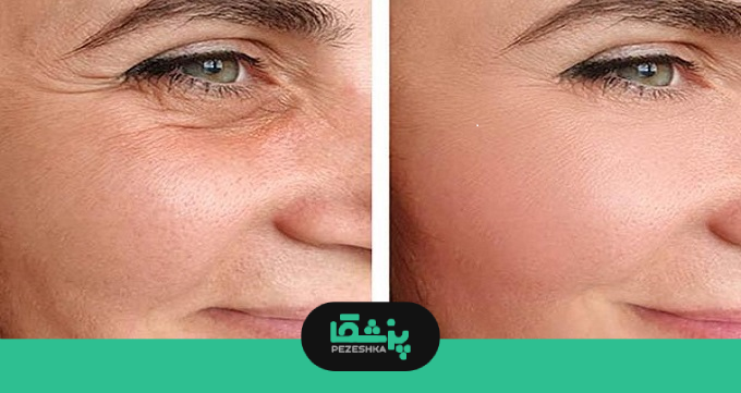 انواع روش‌های جوانسازی پوست
