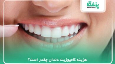 هزینه کامپوزیت دندان چقدر است؟