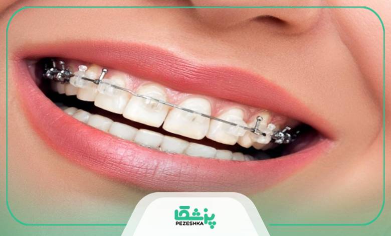 ارتودنسی چیست؟