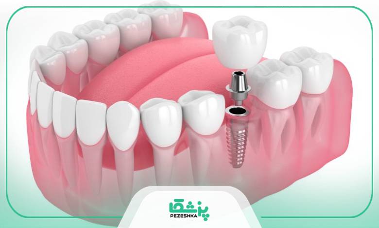 اقدامات قبل از ایمپلنت دندان