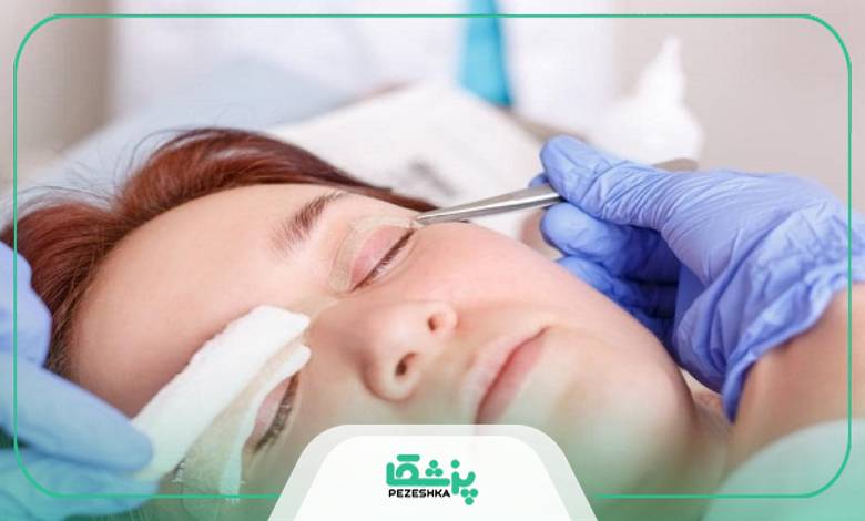 بلفاروپلاستی چیست؟