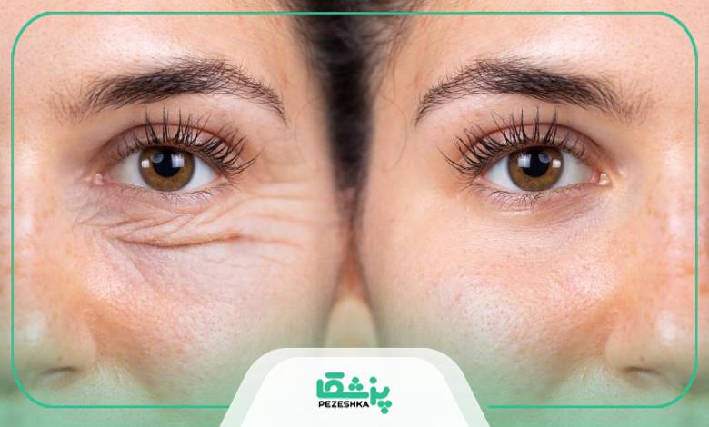 پیری پلک چگونه اتفاق می افتد؟