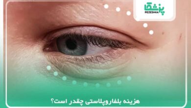 هزینه بلفاروپلاستی چقدر است؟