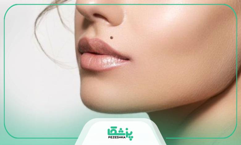 هزینه برداشتن خال معمولی چقدر است؟