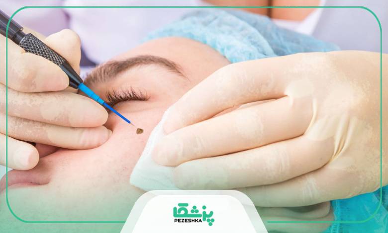 عوامل موثر بر هزینه برداشتن خال