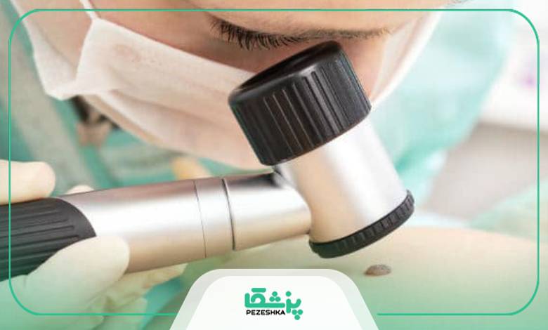 تاثیر محل قرارگیری خال صورت یا بدن بر هزینه برداشتن خال