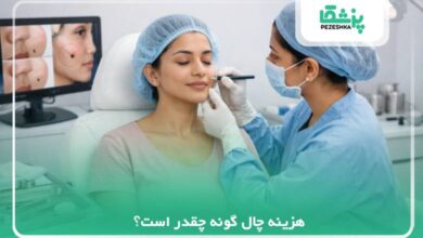 هزینه چال گونه چقدر است؟