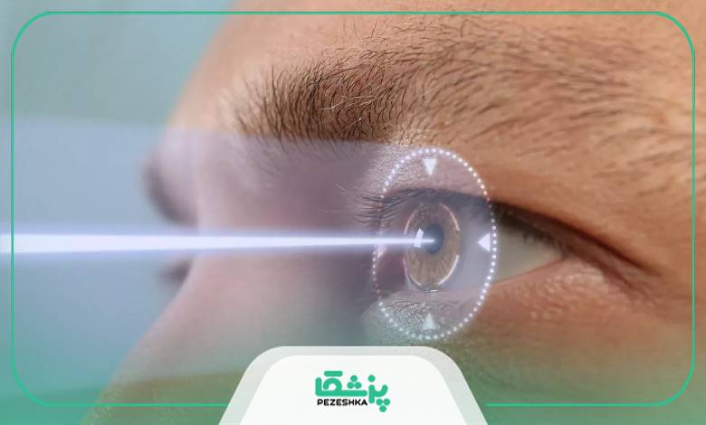 تجهیزات و نوع لیزر چقدر در هزینه لازک چشم تاثیر دارد؟