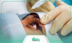 آب مروارید چیست و به چه دلیل ایجاد می شود؟