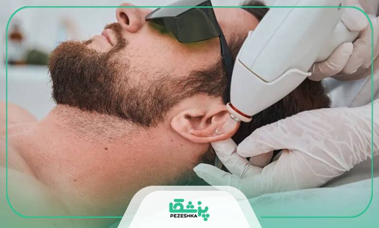 کاربرد لیزر برای موهای زائد