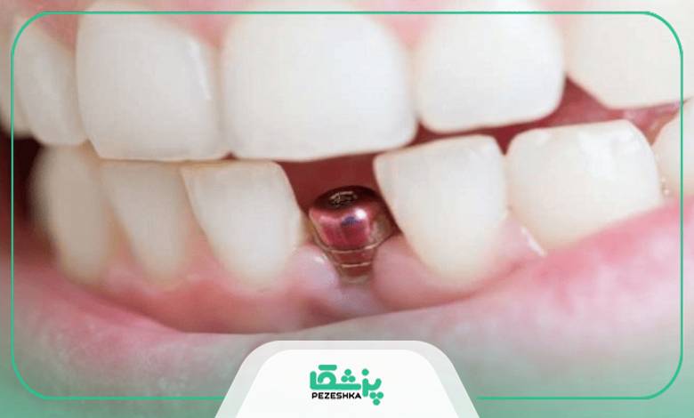 ایمپلنت چیست؟