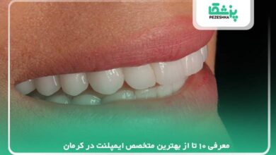 بهترین متخصص ایمپلنت در کرمان