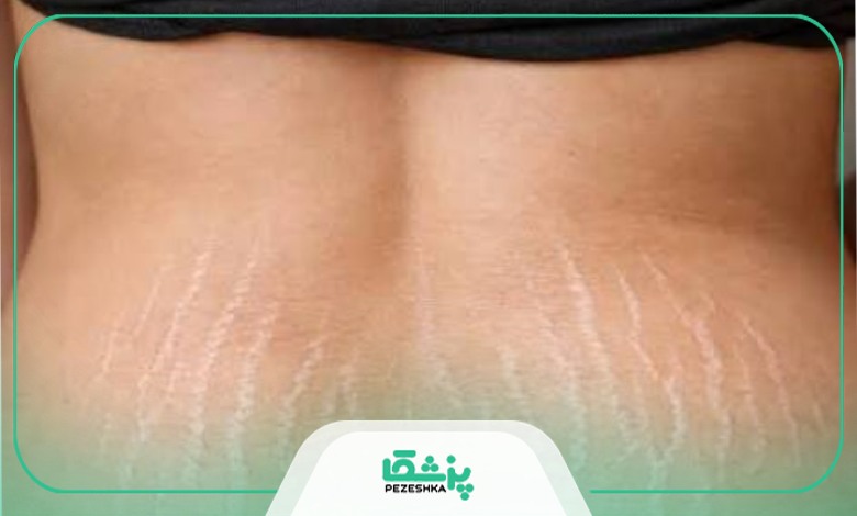 چه افرادی دچار ترک پوستی می شوند؟