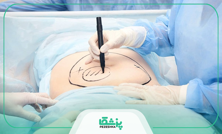 اقدامات بعد از ابدومینوپلاستی