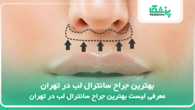بهترین جراح سانترال لب در تهران