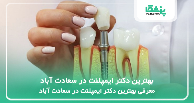 بهترین دکتر ایمپلنت در سعادت آباد