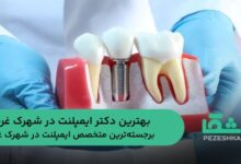 بهترین دکتر ایمپلنت در شهرک غرب